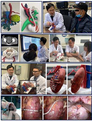 Three-Dimensional Physical Model in Urologic Cancer